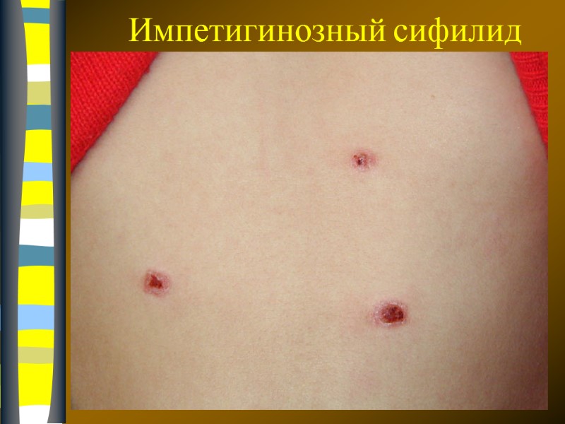 09.12.2017 Импетигинозный сифилид